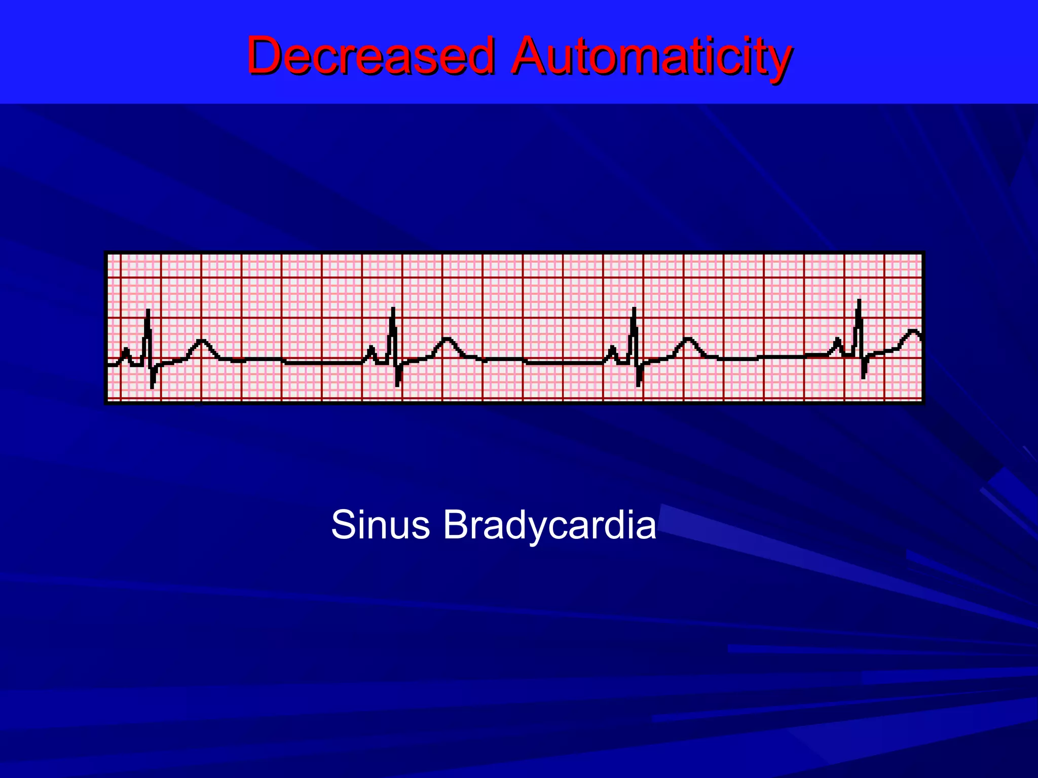 Decreased Automaticity

Sinus Bradycardia

 