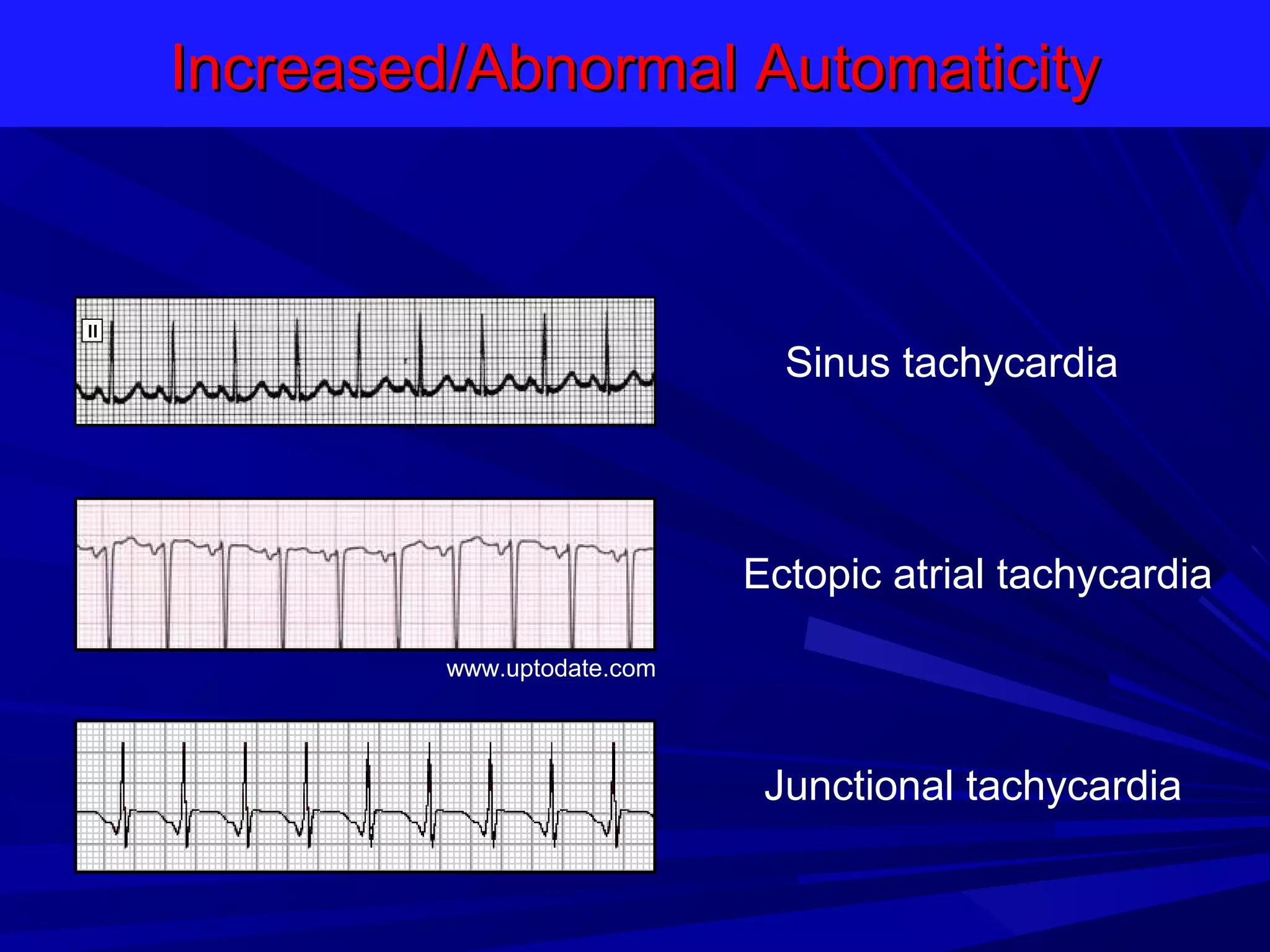 Increased/Abnormal Automaticity

Sinus tachycardia

Ectopic atrial tachycardia
www.uptodate.com

Junctional tachycardia

 
