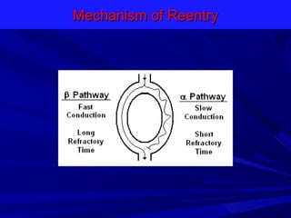Reentry Heart Mechanism of arrythmias | PPT
