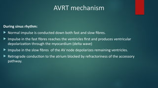 Comprehensive Mechanisms and EKG Characteristics of Cardiac Arrhythmias ...