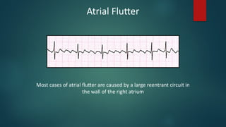 Comprehensive Mechanisms and EKG Characteristics of Cardiac Arrhythmias ...