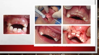 Dyscariasis Mechanism of blood clotting and blood dyscrasias | PPTX