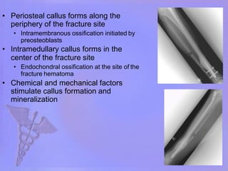 Initial Callus Formation Mechanism of fracture healing and metabolism.pptx