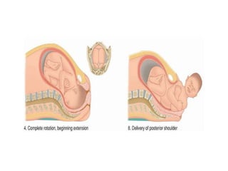 Mechanism of labor | PPSX