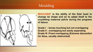 Positional Molding The Mechanism of Normal Labor class.pptx