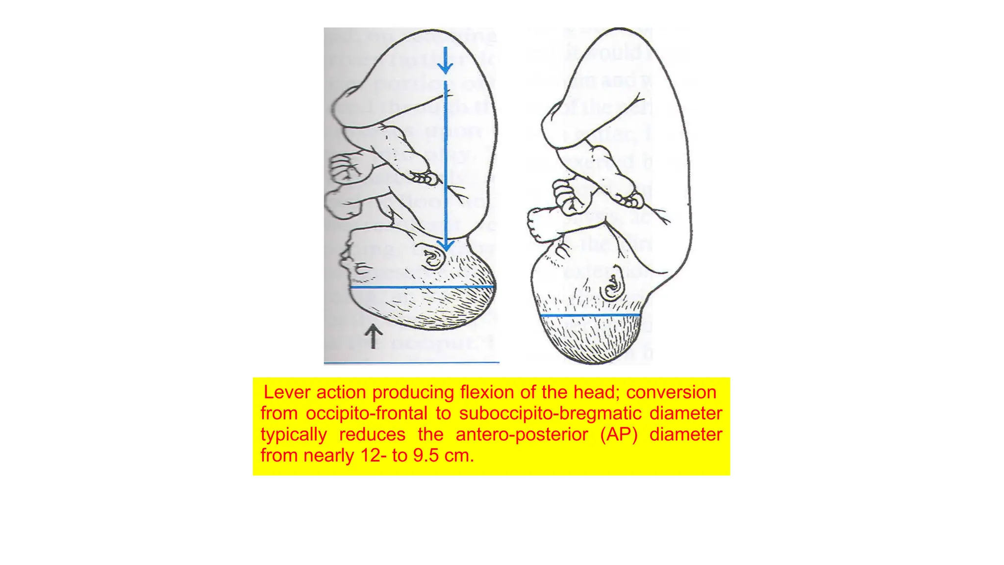 Lever action producing flexion of the head; conversion
from occipito-frontal to suboccipito-bregmatic diameter
typically reduces the antero-posterior (AP) diameter
from nearly 12- to 9.5 cm.
 