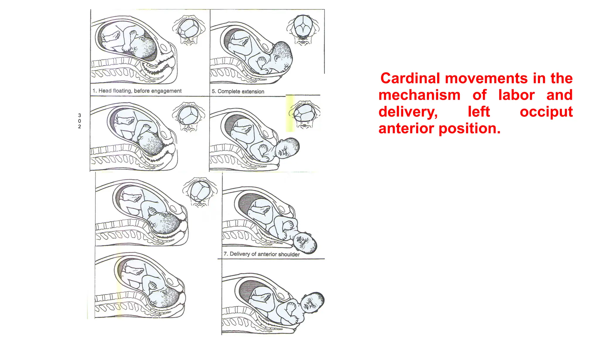 3
0
2
2.Engagement;descent, flexion 6. Restitution (external rotation)
3. Further descent, internal rotation
4. Complete rotation, beginning
extension
Cardinal movements in the
mechanism of labor and
delivery, left occiput
anterior position.
 