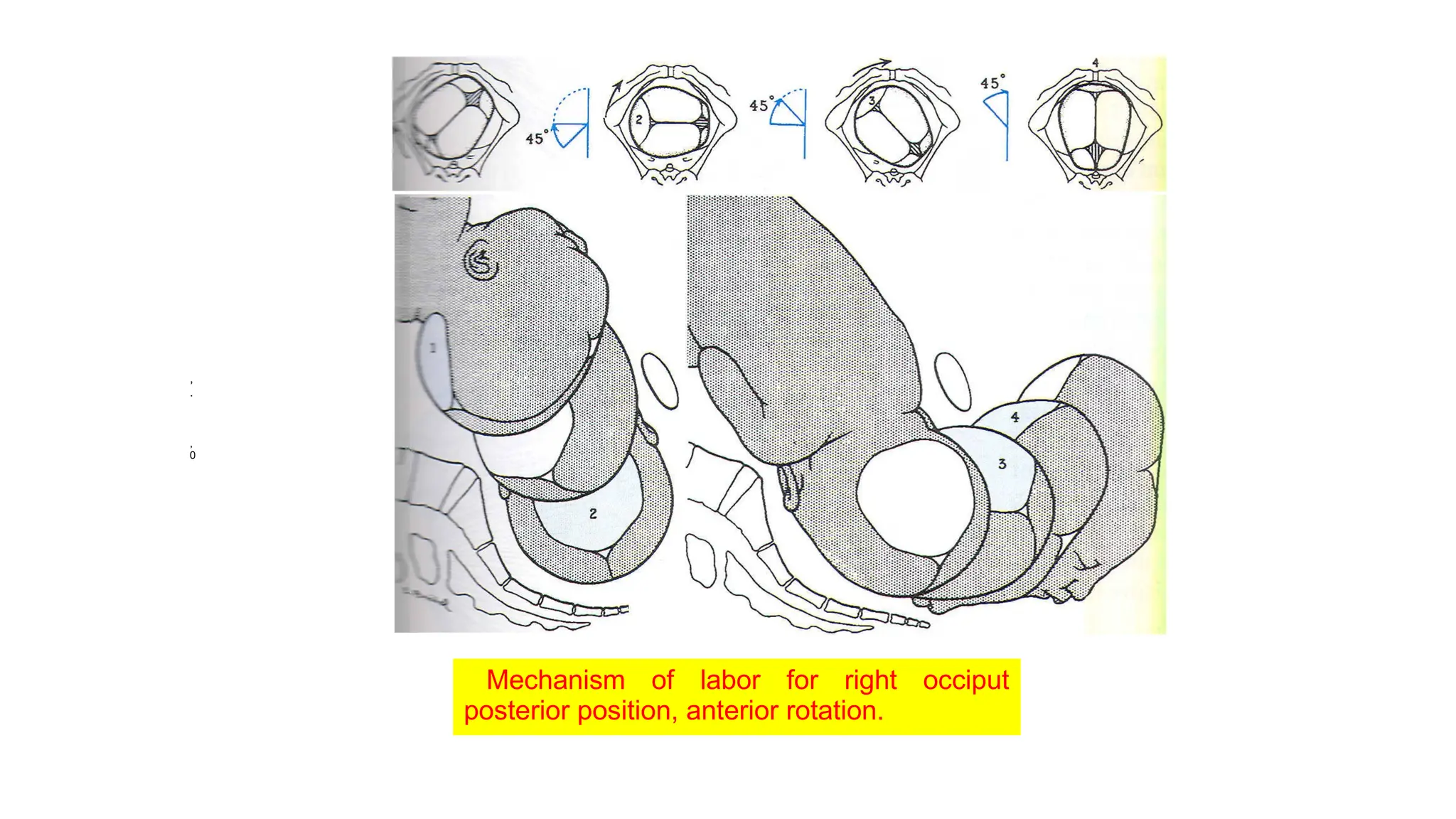 Mechanism of labor for right occiput
posterior position, anterior rotation.
,
.
,
0
 