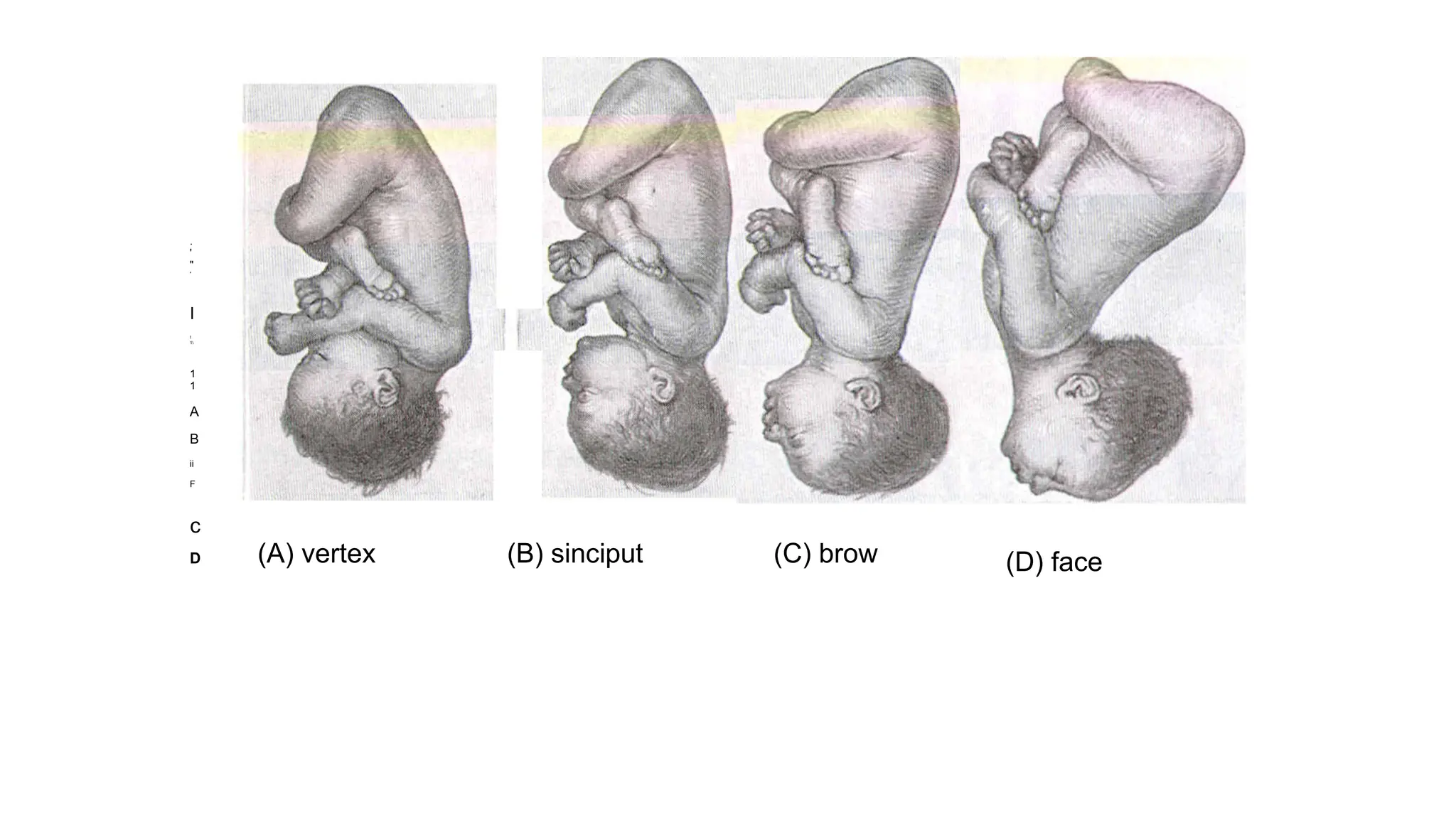 .
'
"
'
I
!
1
1
1
A
B
ii
F
c
D (A) vertex (B) sinciput (C) brow (D) face
 