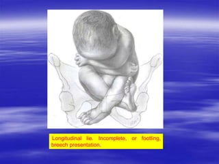 MECHANISM OF LABOUR (NORMAL and ABNORMAL).ppt