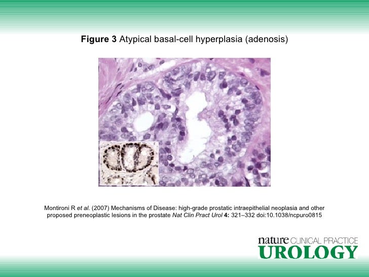 7 of mechanisms disease of grade Mechanisms Disease: prostatic high