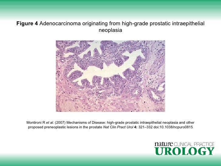 mechanisms 8 disease of prostatic Disease: grade high of Mechanisms