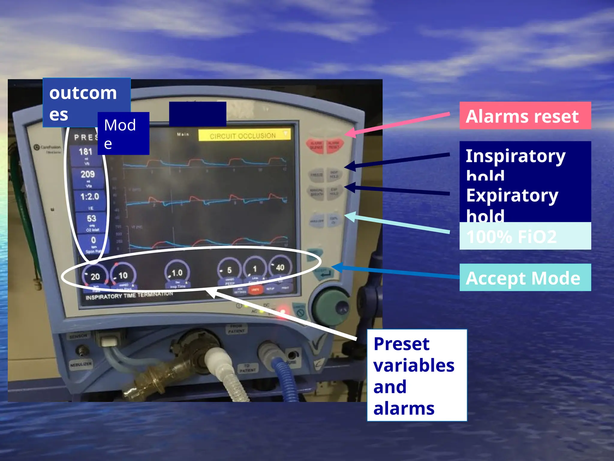 Inspiratory
hold
Expiratory
hold
100% FiO2
Accept Mode
Alarms reset
Preset
variables
and
alarms
outcom
es
Mod
e
 