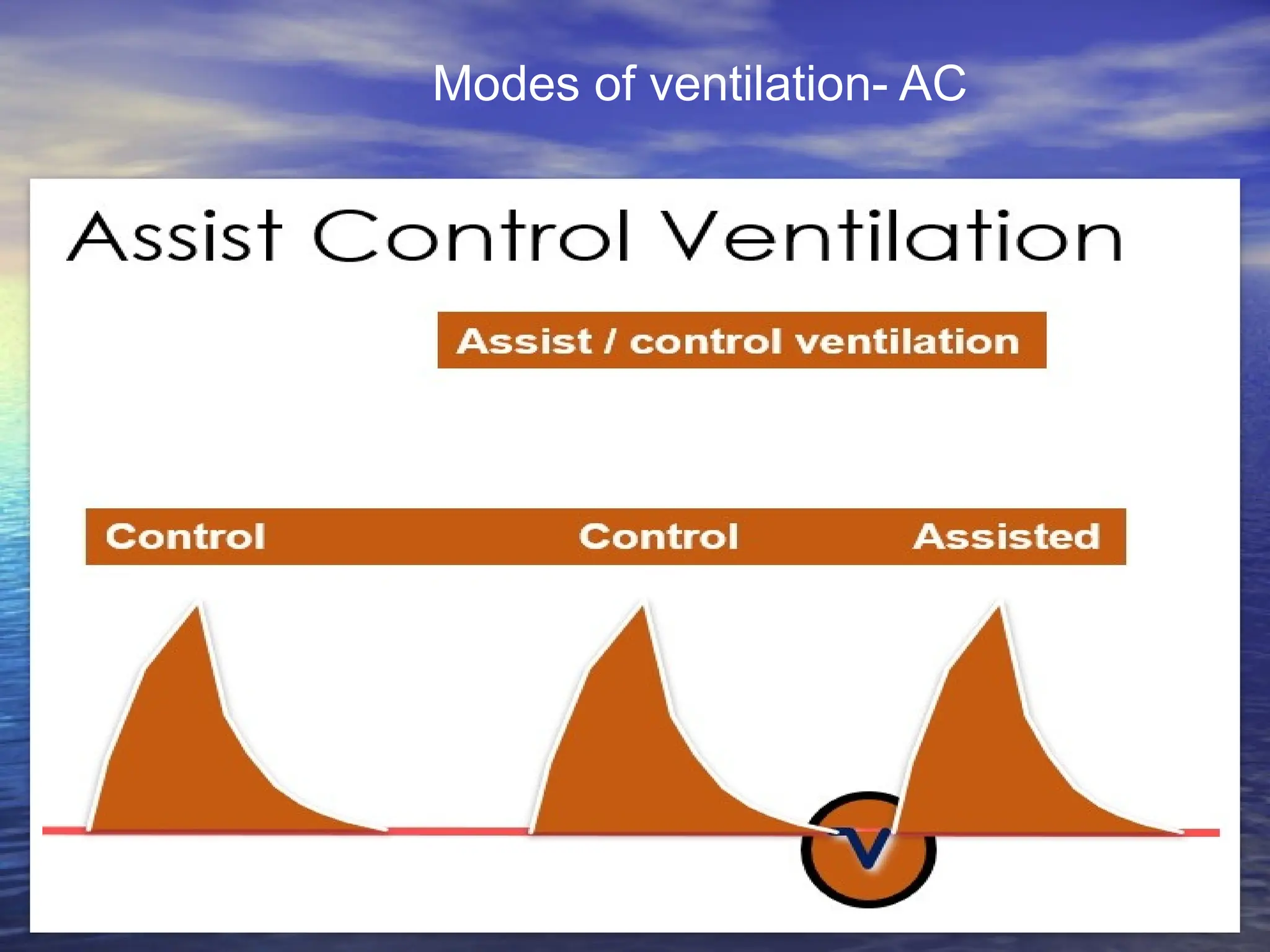 Modes of ventilation- AC
 
