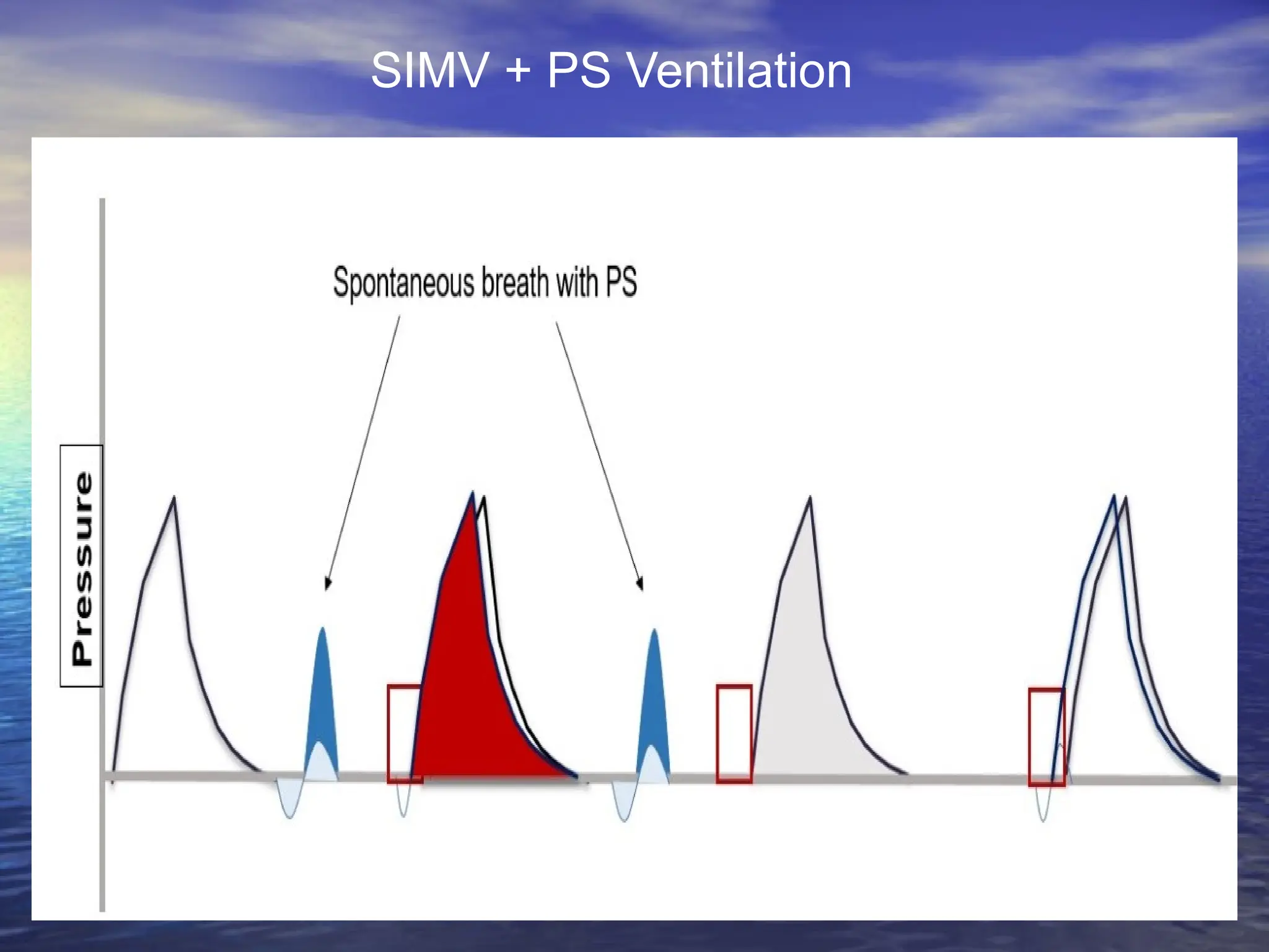 SIMV + PS Ventilation
 