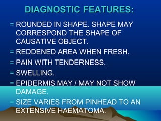 DDIIAAGGNNOOSSTTIICC FFEEAATTUURREESS:: 
= ROUNDED IN SHAPE. SHAPE MAY 
CORRESPOND THE SHAPE OF 
CAUSATIVE OBJECT. 
= REDDENED AREA WHEN FRESH. 
= PAIN WITH TENDERNESS. 
= SWELLING. 
= EPIDERMIS MAY / MAY NOT SHOW 
DAMAGE. 
= SIZE VARIES FROM PINHEAD TO AN 
EXTENSIVE HAEMATOMA. 
 