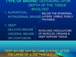 TTYYPPEE OOFF BBRRUUIISSEE:: DDEEPPEENNDDIINNGG UUPPOONN 
DDEEPPTTHH OOFF TTHHEE TTIISSSSUUEE 
IINNVVOOLLVVEEDD 
1. SUPERFICIAL: 
INTRADERMAL BRUISE: 
1. DEEP: 
DELAYED BRUISE 
VISCERAL BRUISE 
OR CONTUSION. 
BELOW THE EPIDERMAL 
LAYERS. VISIBLE, EASILY 
PALPABLE. 
INVOLVING VASCULATURE 
OF MUSCLES, ORGANS & 
DEEP ADIPOSE TISSUE. 
DEEP BRUISE MAY BECOME EVIDENT AFTER 
THE LAPSE OF SOME TIME (2-3 DAYS). 
 
