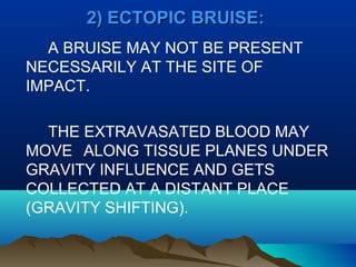 22)) EECCTTOOPPIICC BBRRUUIISSEE:: 
A BRUISE MAY NOT BE PRESENT 
NECESSARILY AT THE SITE OF 
IMPACT. 
THE EXTRAVASATED BLOOD MAY 
MOVE ALONG TISSUE PLANES UNDER 
GRAVITY INFLUENCE AND GETS 
COLLECTED AT A DISTANT PLACE 
(GRAVITY SHIFTING). 
 