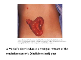 A Meckel’s diverticulum is a vestigial remnant of the
omphalomesenteric (vitellointestinal) duct
 