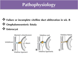  Failure or incomplete vitelline duct obliteration in wk. 8
 Omphalomesenteric fistula
 Enterocyst
Pathophysiology
 