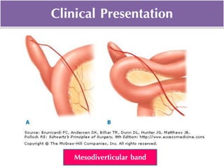 Clinical Presentation
Mesodiverticular band
 