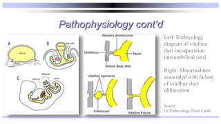 Pathophysiology cont’d
Left: Embryology
diagram of vitelline
duct incorporation
into umbilical cord
Right: Abnormalities
associated with failure
of vitelline duct
obliteration
Source:
GI Embryology Flash Cards
 
