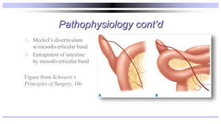 Pathophysiology cont’d
A. Meckel’s diverticulum
w/mesodiverticular band
B. Entrapment of intestine
by mesodiverticular band
Figure from Schwartz’s
Principles of Surgery, 10e
 