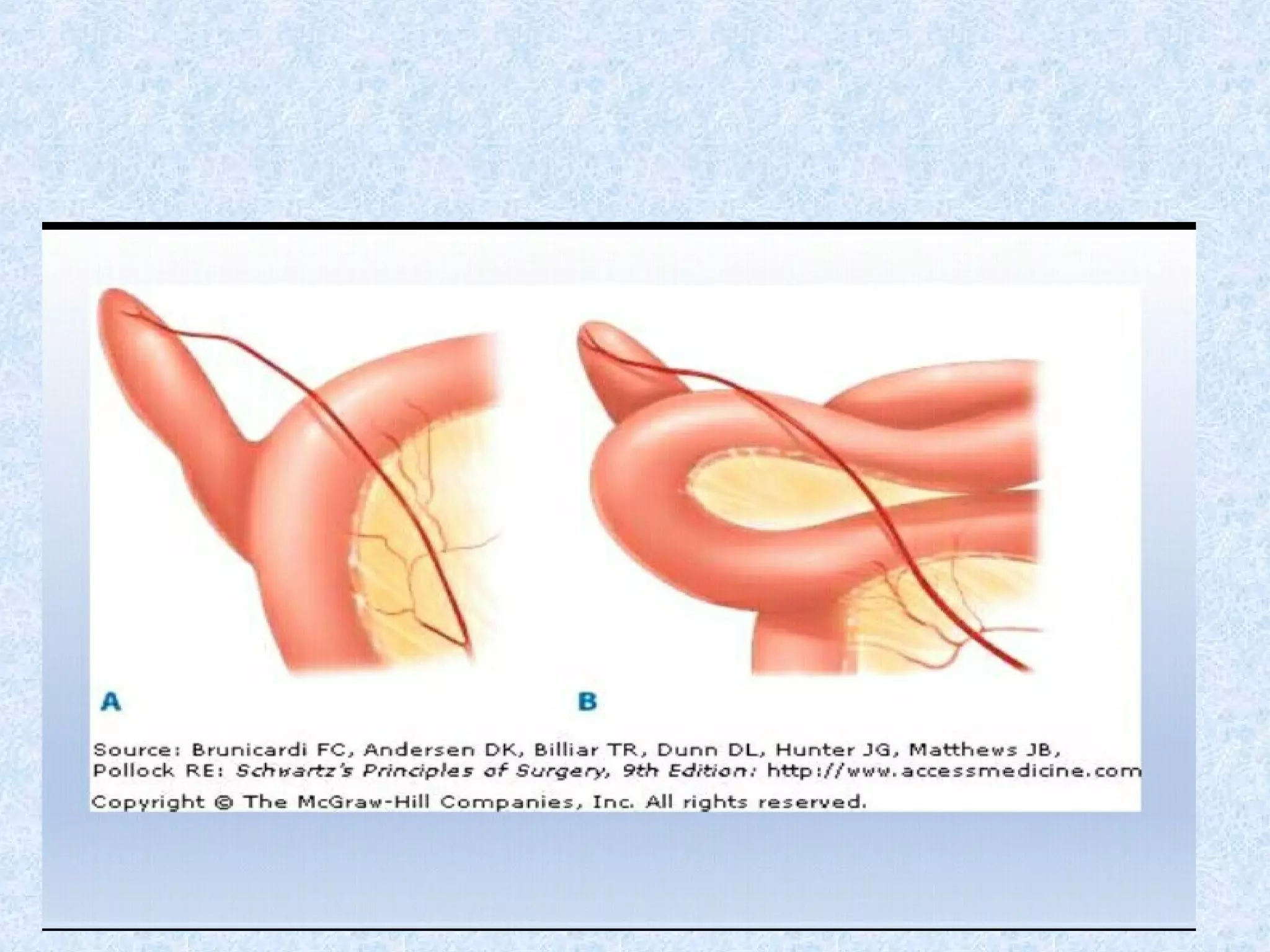 Meckel's Band Illustration