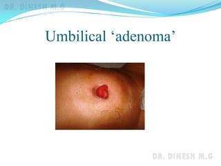 Umbilical ‘adenoma’
 