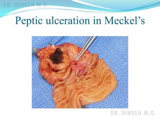 Peptic ulceration in Meckel’s
 