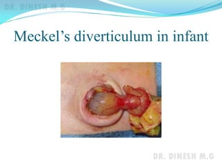 Meckel’s diverticulum in infant
 