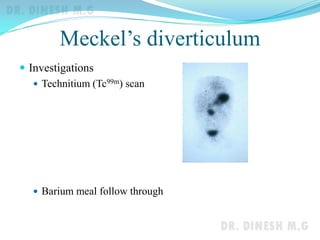 Meckel’s diverticulum
 Investigations
 Technitium (Tc99m) scan
 Barium meal follow through
 