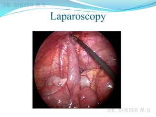 Laparoscopy
 