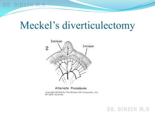 Meckel’s diverticulectomy
 