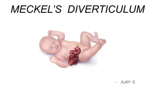 MECKEL’S DIVERTICULUM
- AJAY S
 