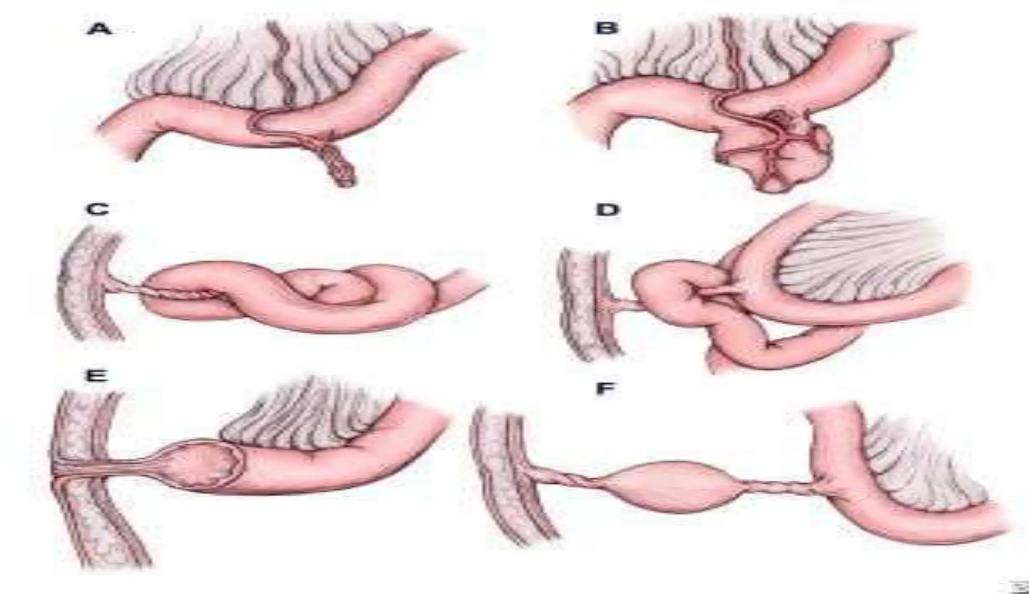 Meckel Process meckels diverticulum.pptx