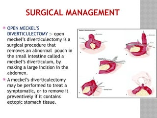 Meckel Process Comprehensive Overview of Meckel’s Diverticulum: Development, Diagnosis ...