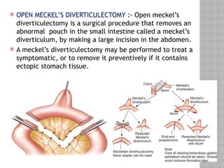 Meckel Process Comprehensive Overview of Meckel’s Diverticulum: Development, Diagnosis ...