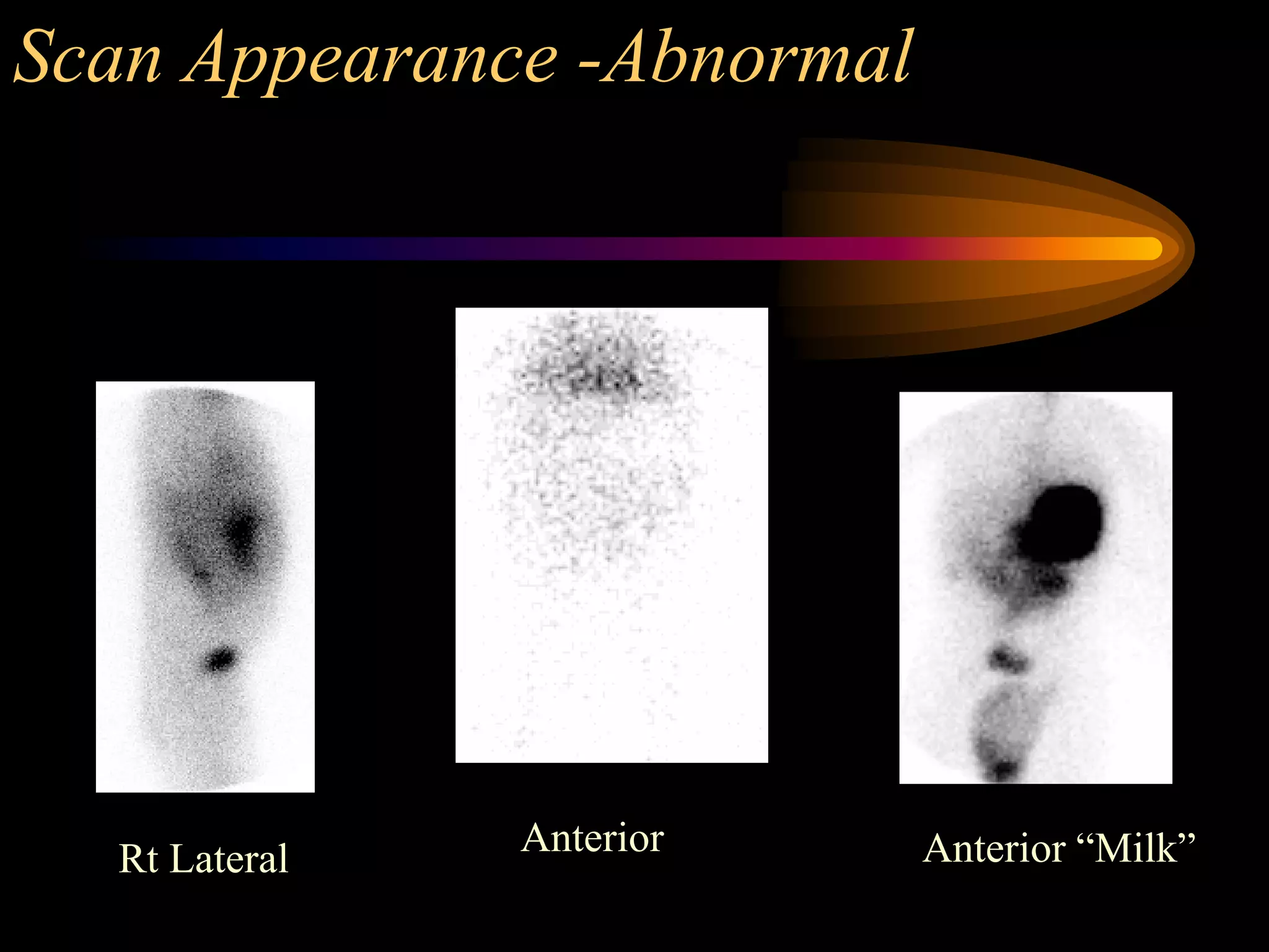 Meckels diverticulum - a nuclear medicine case study | PDF