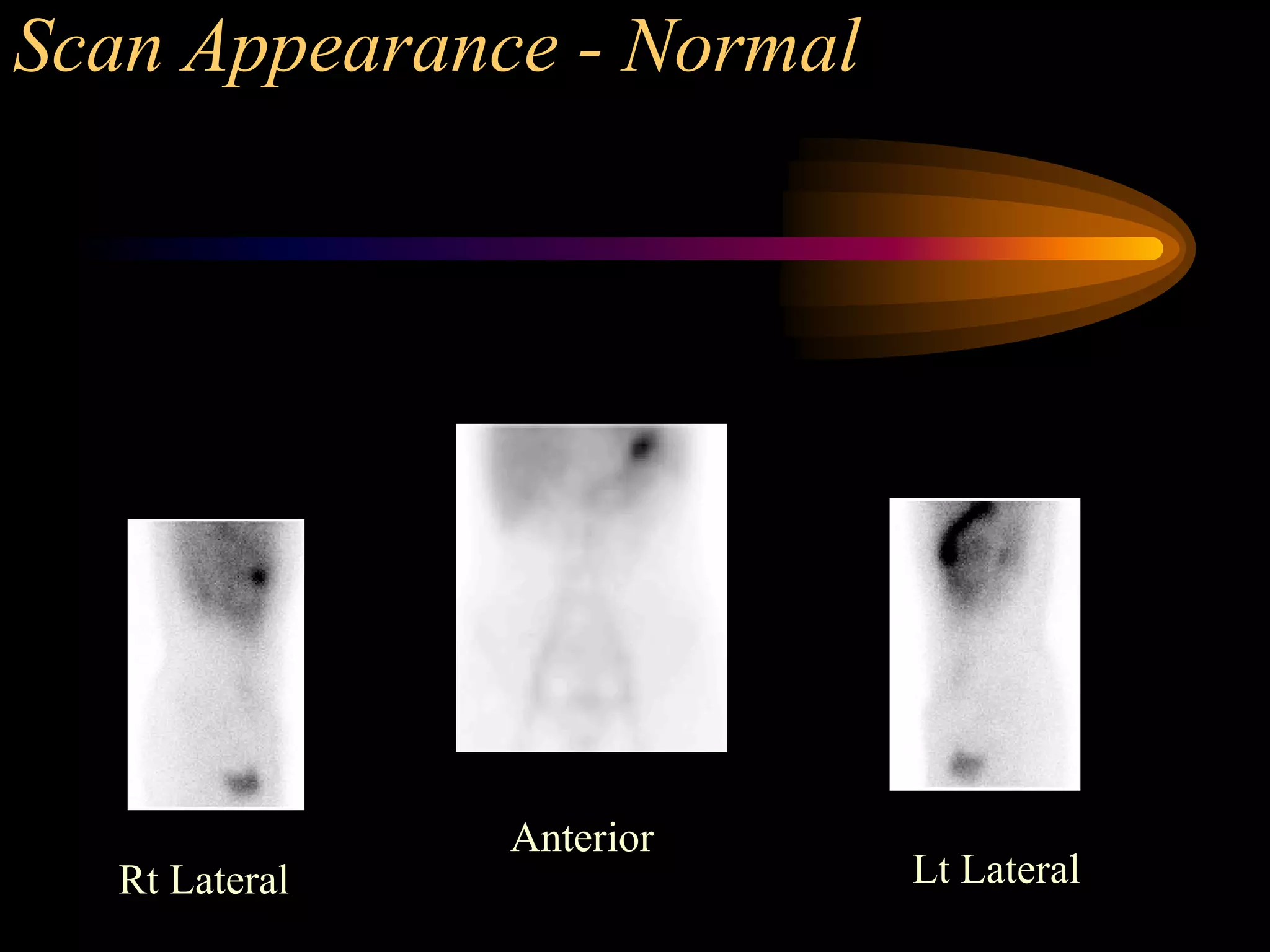 Meckels diverticulum - a nuclear medicine case study | PDF