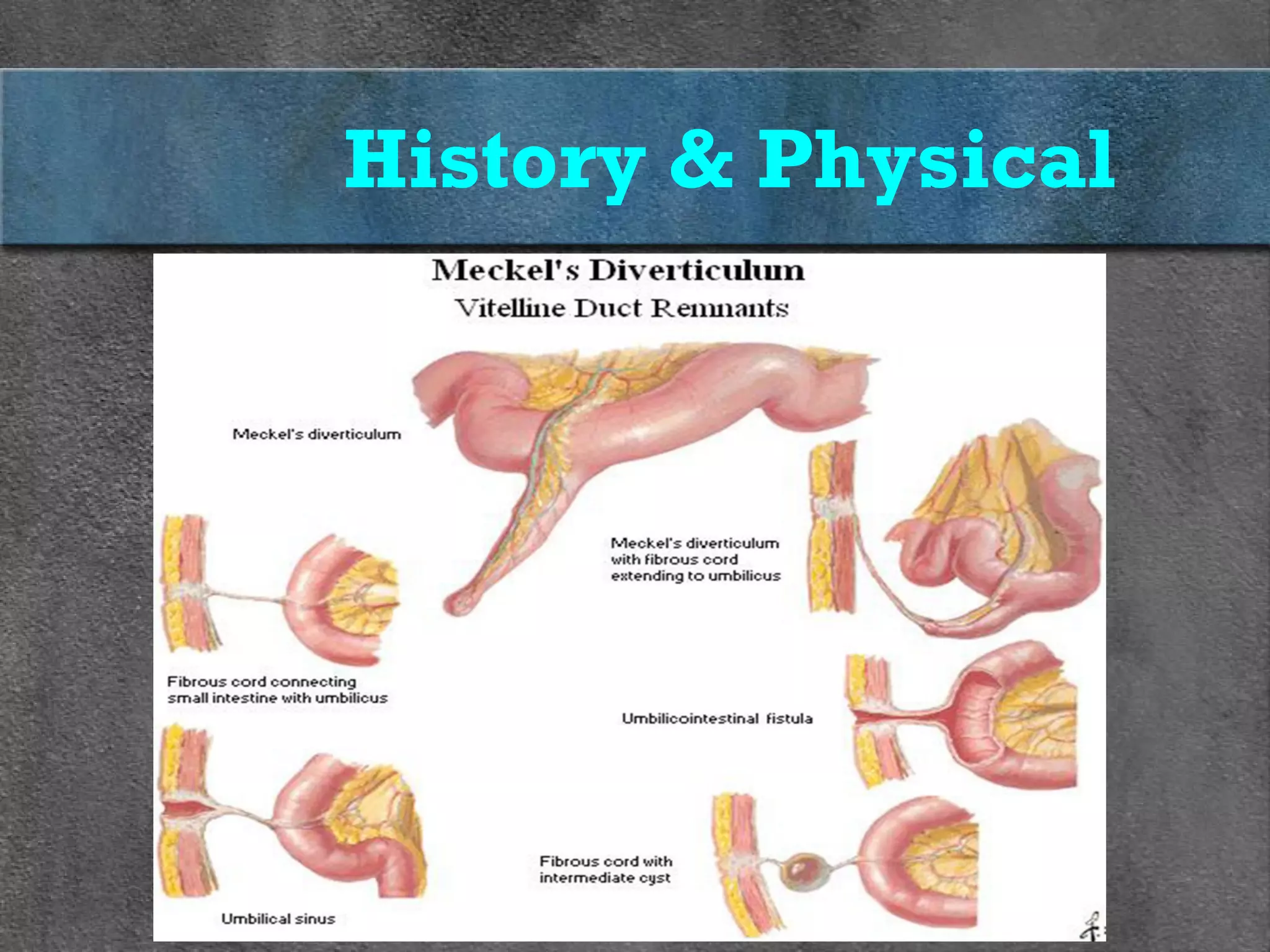 Meckel Process Meckel's Diverticulum - Pediatric Surgery | PPT