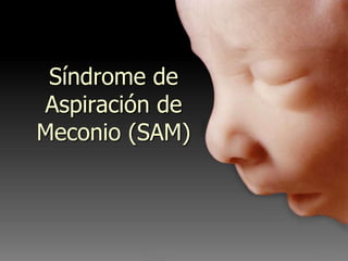 Síndrome de
Aspiración de
Meconio (SAM)
 