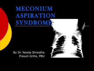 MECONIUM ASPIRATION SYNDROME By Dr. Needa Shrestha Prasuti Griha, PBU 