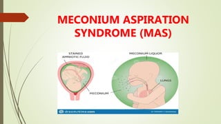 MECONIUM ASPIRATION
SYNDROME (MAS)
 