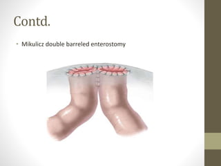 Contd.
• Mikulicz double barreled enterostomy
 