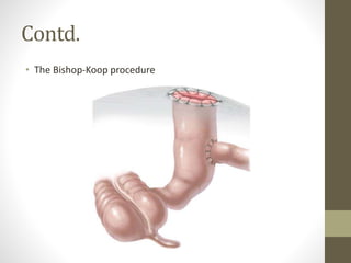 Contd.
• The Bishop-Koop procedure
 