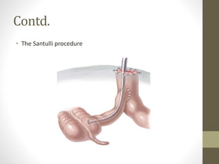 Contd.
• The Santulli procedure
 