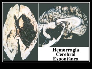 Hemorragia  Cerebral  Espontânea  