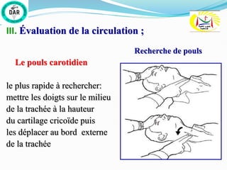 III. Évaluation de la circulation ;
Recherche de pouls
Le pouls carotidien
le plus rapide à rechercher:
mettre les doigts sur le milieu
de la trachée à la hauteur
du cartilage cricoïde puis
les déplacer au bord externe
de la trachée
 