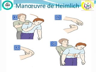 Manœuvre de Heimlich
① ②
③
④
 
